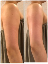 ヴィータサナ(Vita-Sana)/◆二の腕引締め◆ブライダルにも