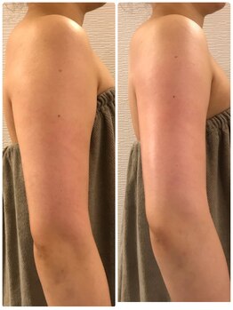 ヴィータサナ(Vita-Sana)/◆二の腕引締め◆ブライダルにも