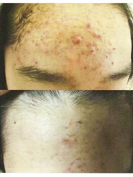 デジール/【プラズマニキビケア】