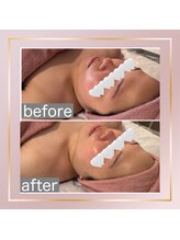 ベルメール(Bellemer)/カーボキシー施術のお客様♪