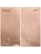 チップ(chip)/経過写真（ビフォーアフター）