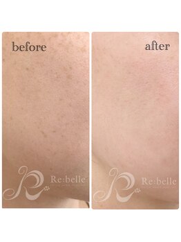 チップ(chip)/経過写真(ビフォーアフター)