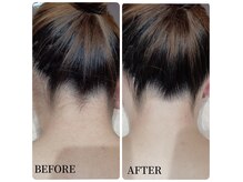 うなじ脱毛で後ろ姿美人♪