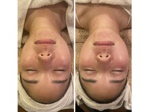 うつくし痩身 美サロン ゼットワン(Z-ONE)/ハイドロ＆カーボキシーパック