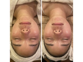 うつくし痩身 美サロン ゼットワン(Z-ONE)/ハイドロ＆カーボキシーパック