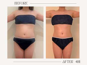 シーアンル(C.aneL)/施術ビフォーアフター 4回