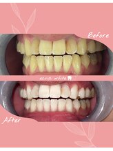 エクシアホワイトニング 札幌中島公園店/ホワイトニングビフォーアフター