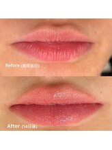サロンヴェアリー 広尾(salon vary)/メラニンケア！ぷるぷるな唇に