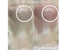 ピエル 北千住店(PIEL)/美白マスク