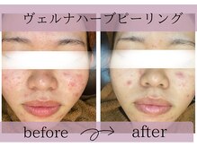 サロンドボーテアリス (Salon de beaute ALICE)/ヴェルナハーブピーリング