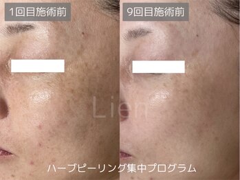 リアン/ハーブピーリング集中プログラム