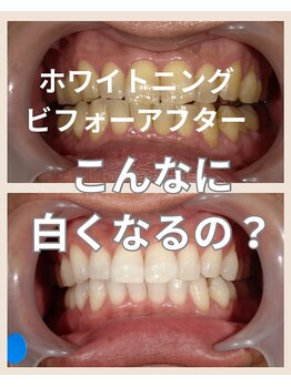 ジンヒ(Jinhi)の写真/専門機関監修ホワイトニングでワンランク上の輝きを★1回の照射でトーンアップを実感◎理想の美しい歯に♪