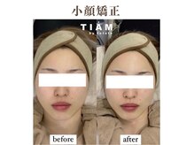 ティアム バイ テトテ 神戸三宮(TIAM by tetote)/小顔矯正