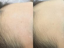 リコ バイ グラス(Rico by GRASS)/おでこの産毛