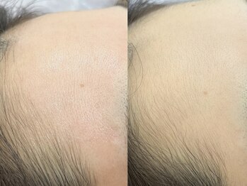 リコ バイ グラス(Rico by GRASS)/おでこの産毛