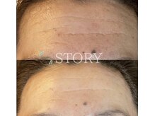 ストーリー 岐阜店(STORY)/ハーブピーリング専門店STORY