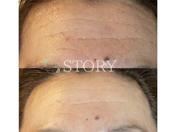 ストーリー 岐阜店(STORY)/ハーブピーリング専門店STORY