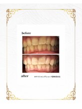 ホワイトニングショップ 葵区静岡駅店/セルフホワイトニング施術