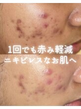 リルビー(Lilby)/ニキビ改善・ハーブピーリング