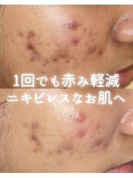 リルビー(Lilby)/ニキビ改善・ハーブピーリング