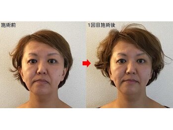 整体院プラス/小顔矯正モニター