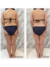 ラニ(LANI)/キャビテーション