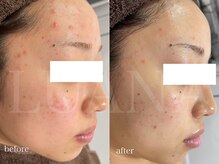 ルアナ(LUANA)/赤みとニキビケア