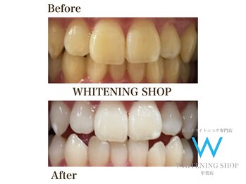 ホワイトニングショップ 甲賀店/Before&After『ホワイトニング』