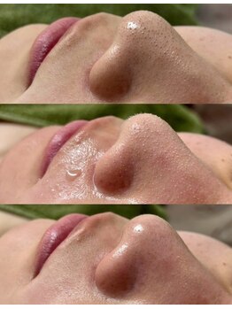 エステサロン ジョアアンジェ(joie ange)/飛び出す汚れ、角栓!