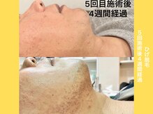 エクレ 柏店(EKURE)/ヒゲ脱毛