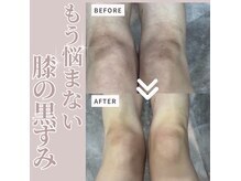ソワン 小岩店(Soin)/30代　膝の黒ずみ
