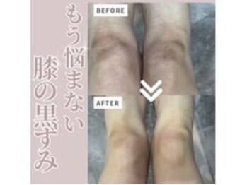 ソワン 小岩店(Soin)/30代 膝の黒ずみ