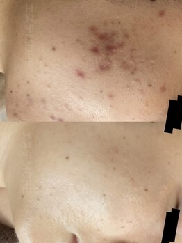 リラクゼーションエステ モア(MORE)/肌荒れケア