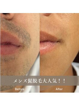 カラー(COLOR)/最新LED脱毛機導入!!