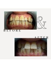 とぅるりん 肌質改善/お試しあれ♪一回で白さ実感！