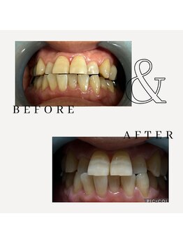 とぅるりん 肌質改善/お試しあれ♪一回で白さ実感！