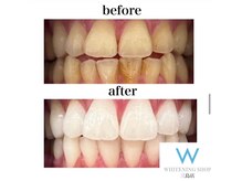 ホワイトニングショップ 三島店(WHITENING SHOP)/着色汚れもしっかり落ちます！