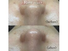 リル バイ アンドアール(Rire by and.R)の雰囲気（【毛穴改善メニュー】毛穴の詰まり、黒ずみ、開きが気になる方に）