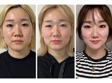 仙豆のちから 自由が丘店/テラボーラー1年後の変化