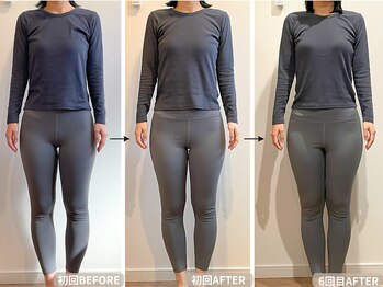 ラーナビコツ(RANA-bikotsu)/【O脚】骨から矯正すると…