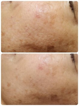 プレイス 太融寺店(PLACE)/ハーブピーリング