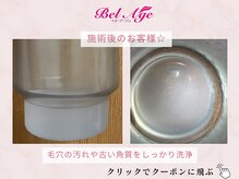 ベル アージュ/毛穴洗浄術後♪