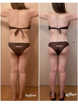 アンフィニ(infini)/短期集中全身コース6回(2ヶ月)
