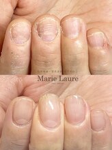 マリーロール 梅田店(Marie Laure)/自爪育成/深爪矯正/ネイルケア