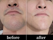 ユアースタイル 四日市店(YOUR Style)/【メンズ脱毛】ヒゲ脱毛 #脱毛