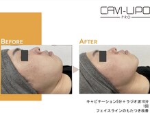 ルピエ(Lupir)/ビフォーアフター