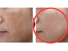 サロンドボーテ ヴィクトワール マルヤマ(Salon de beaute VICTOIRE MARUYAMA)/医師監修◎シミの改善！