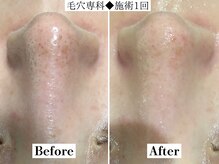 フレイヤ(FREYA)/毛穴専科Before→After