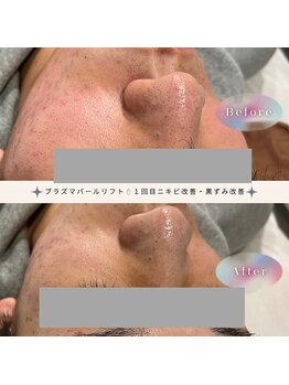 ディアー(Dear)/プラズマパールリフト