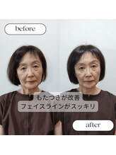 キューサッポロ(SalonQSapporo)/フェイスラインビフォーアフター